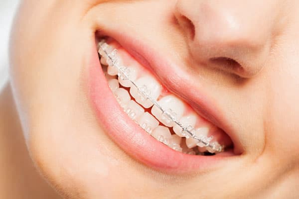 brackets en Lugo