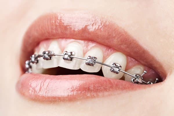 brackets metálicos en Lugo