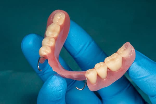 Prótesis dentales removibles